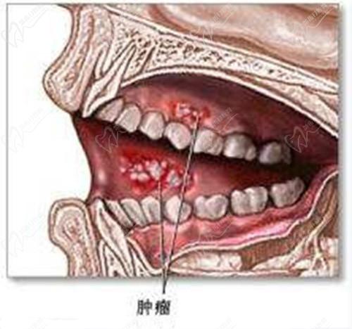 牙癌有什么症状图片