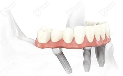 上海半口种植牙医生谁厉害？