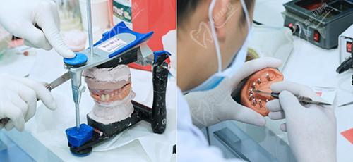 惠州麦芽口腔义齿加工