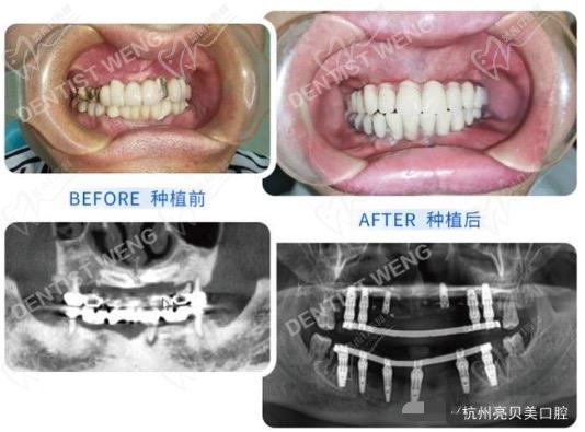 杭州亮贝美口腔医院翁于杰全口种植牙病例