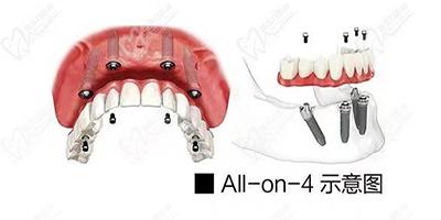 All-on-4种植技术示意图