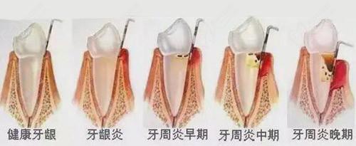 牙周炎发展