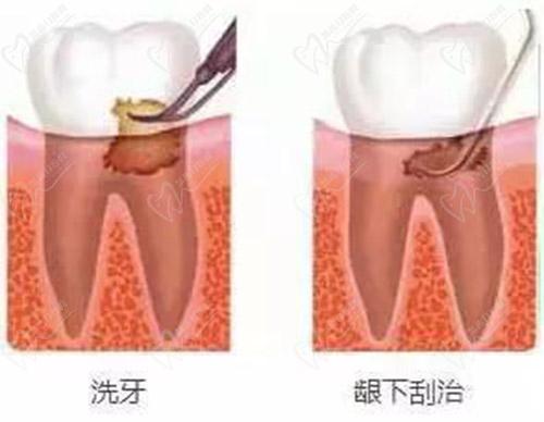 洗牙和龈下刮治