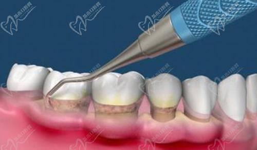 龈下刮治