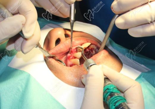 牙周超声设备去除残留龈下结石