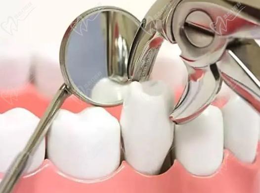 那么做牙齿矫正为什么要先拔牙呢？