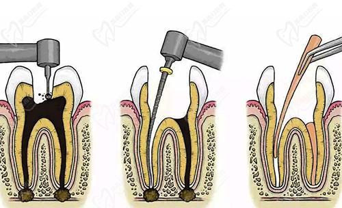 牙齿根管治疗步骤示范