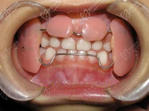 乳牙反颌矫正器
