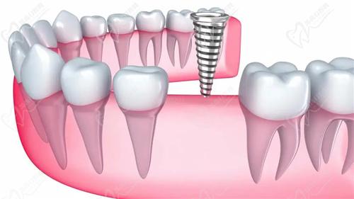 玉林蓝天口腔诊疗价格表