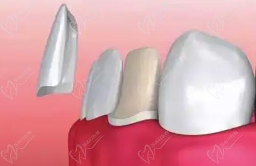 磨除过量牙釉质导致牙齿敏感