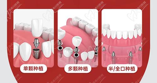 保定牙博士口腔牙齿种植