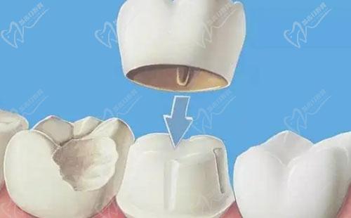 常见牙齿修复方式有哪些