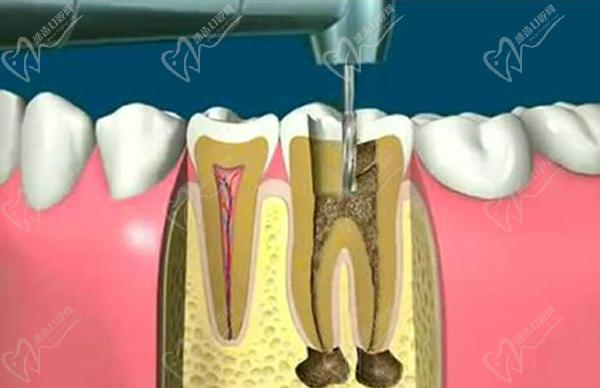 显微根管治疗