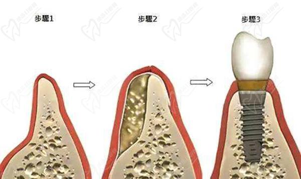 种植牙骨粉和骨膜在什么情况下使用