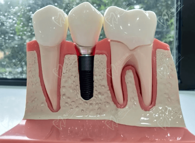 种植牙的价格贵吗