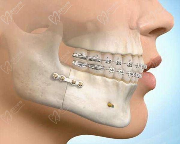 骨性凸嘴必须做正颌手术吗