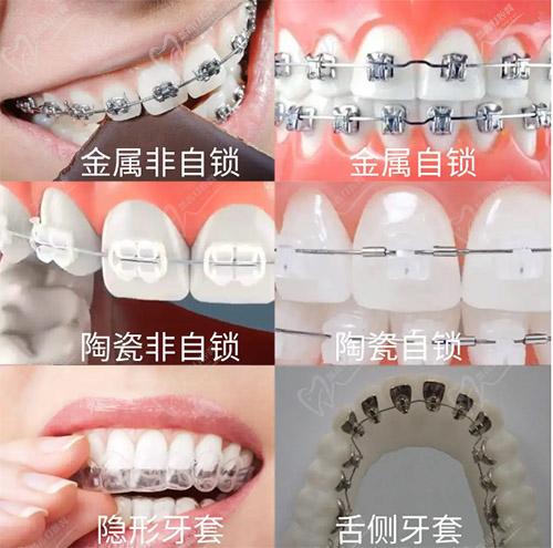 牙齿矫正种类