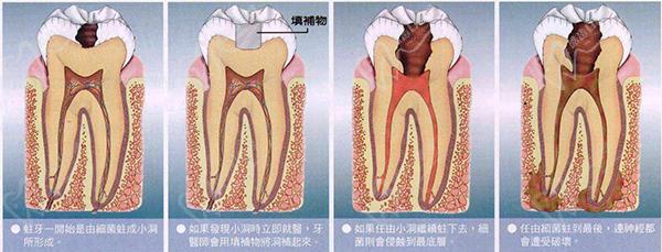 牙髓炎发展过程