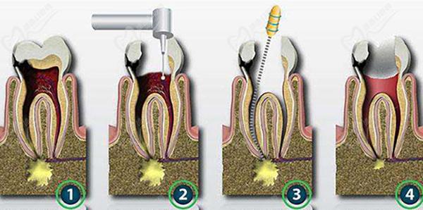 牙髓炎根管治疗步骤图