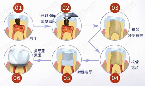 根管治疗的步骤过程