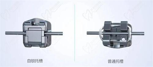 杭州雅莱口腔金属托槽矫正