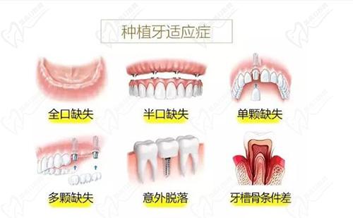 种植牙适用人士