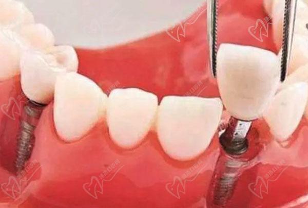 种植牙的五大危害（种植牙有什么风险和后遗症）