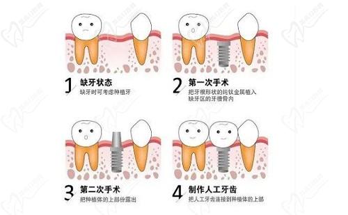 种植牙示意