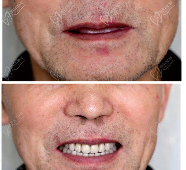 中老年牙齿全口种植修复