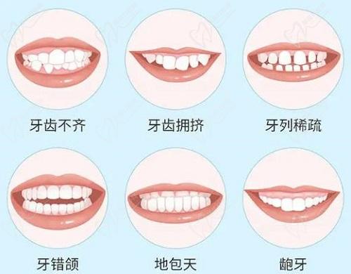 牙齿矫正图示 牙齿矫正图示