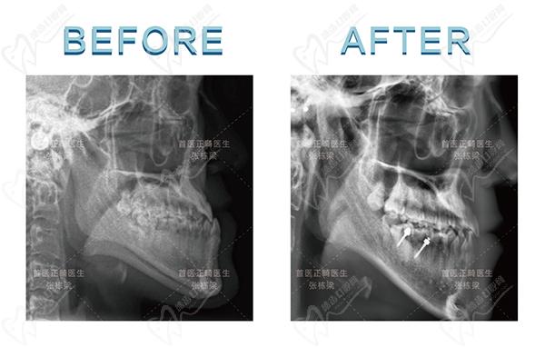 北京禾禾齿科正畸技术治疗对比结果