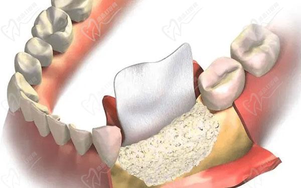 种植牙骨粉填充后悔死了，种植牙骨粉填充后很痛发肿是什么原因啊