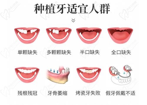 种植牙适合人群