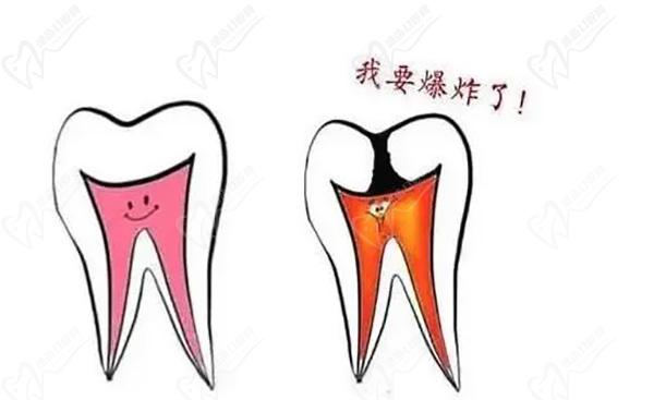 牙髓炎属于几级疼痛？判断牙髓炎很可靠的检查方法
