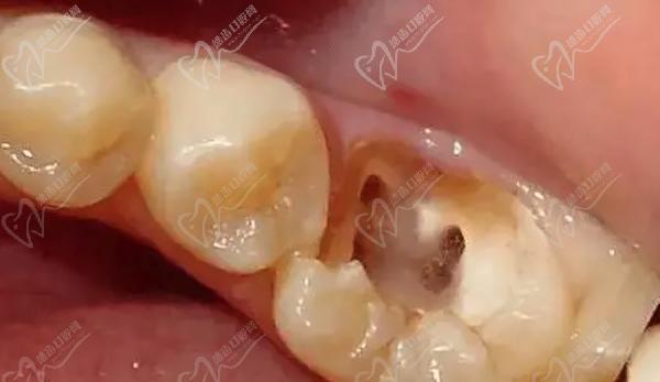 牙髓炎属于几级疼痛？判断牙髓炎很可靠的检查方法