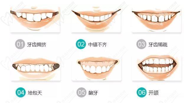 牙齿矫正