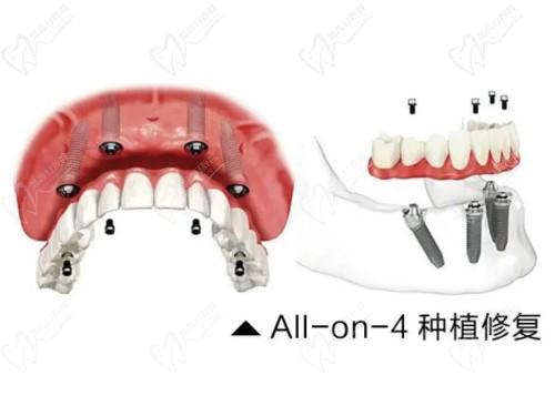 宝应牙管家口腔all-on-4种植技术