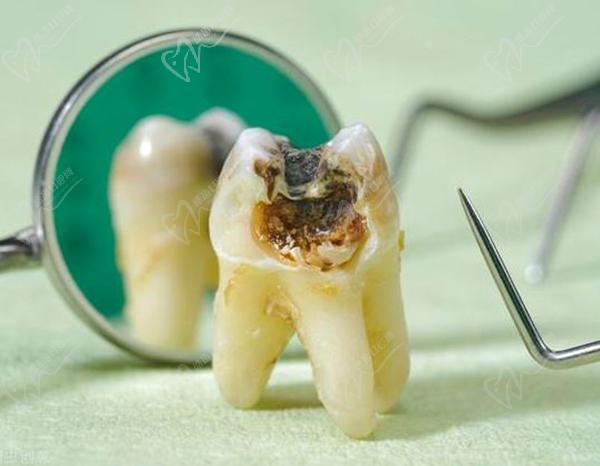 根管治疗后必须做牙套吗