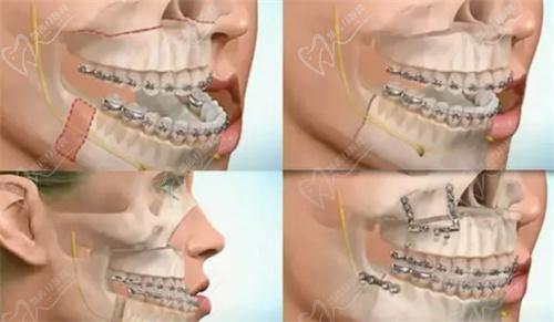广州广大正颌手术怎么样？