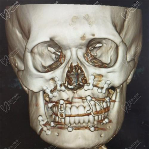 广州广大正颌手术怎么样？