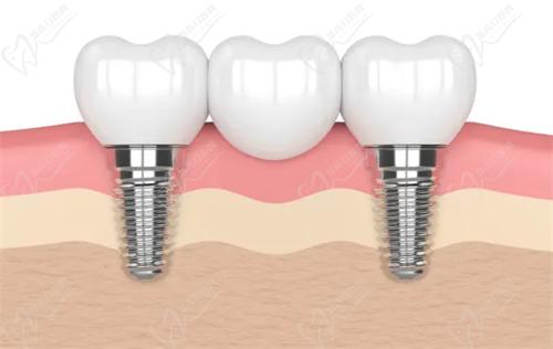 北京京谊种植牙价目表