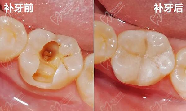美国3M树脂补牙