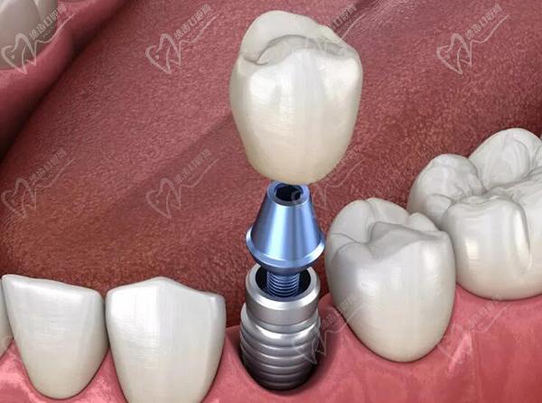老人满口假牙戴不住了，可以通过种植牙齿方式来改善微创即刻种植牙手术过程介绍