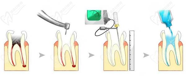 根管治疗怎么操作