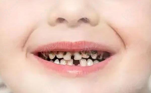 我国5岁孩子龋齿率高达71%，孩子龋齿很已经烂到牙根里面了怎么办