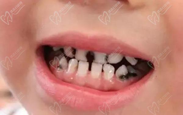 孩子龋齿很重已经烂到牙根里面了怎么办