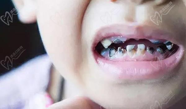 孩子龋齿很重已经烂到牙根里面了怎么办