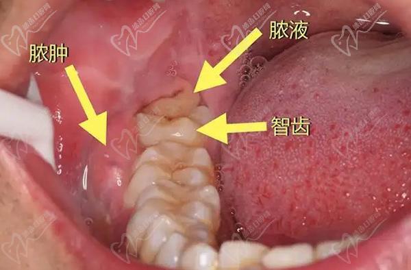 新冠阳了智齿发炎怎么办？牙医教你智齿发炎怎么快速消炎止痛