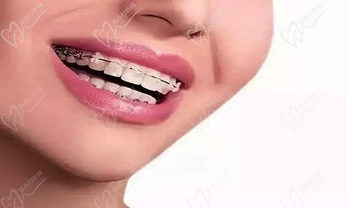 金属托槽牙齿矫正