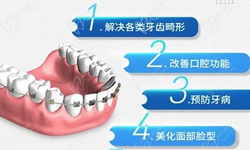 金属托槽牙齿矫正